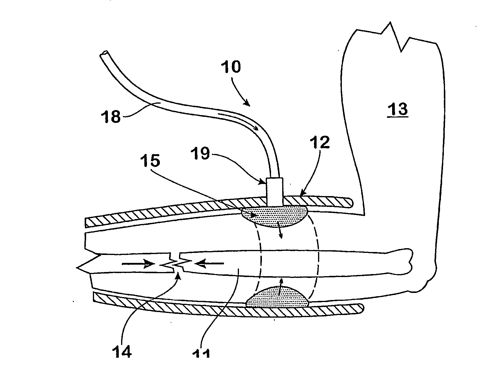 Apparatus and method for treatment of long bone fractures