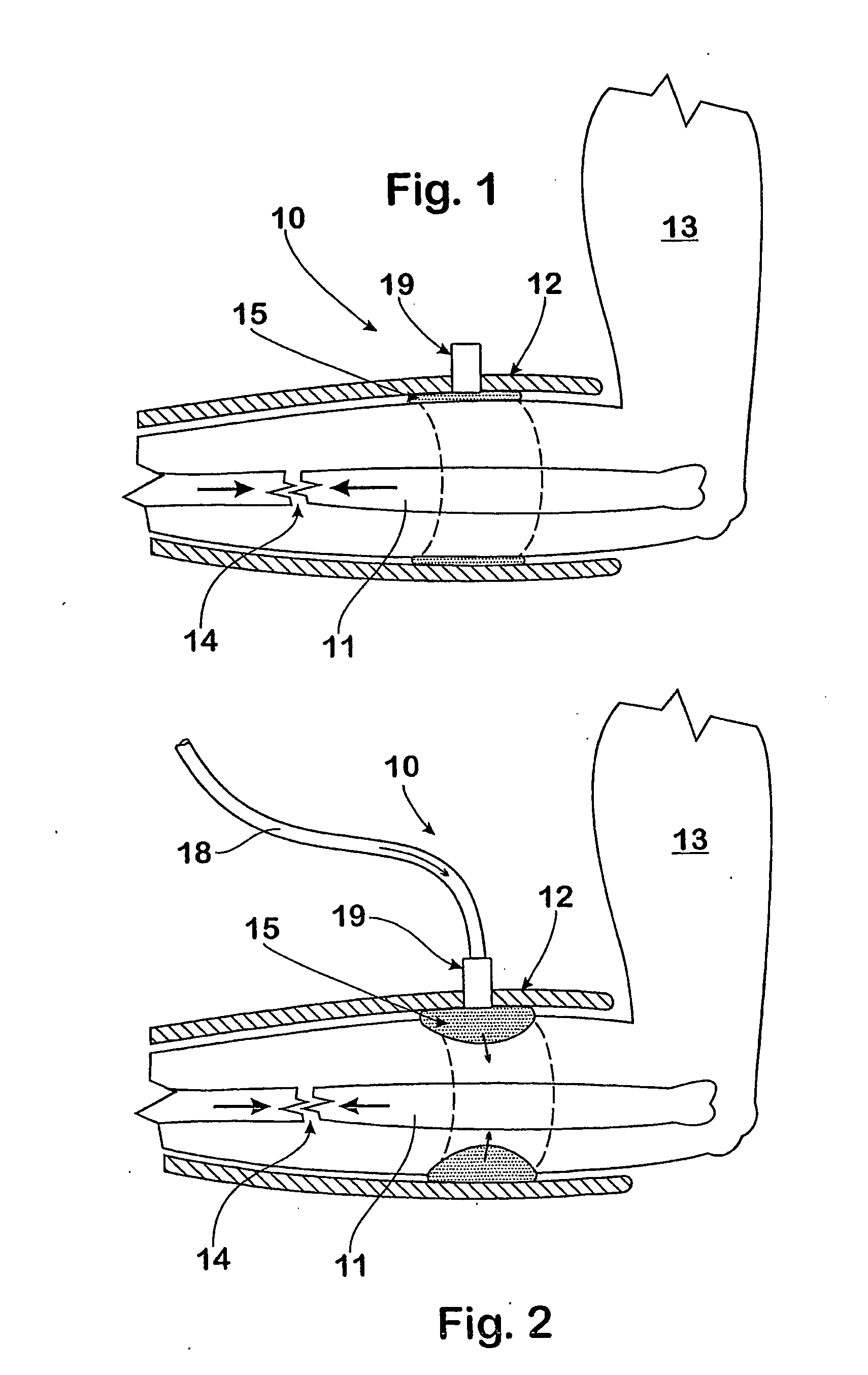 Apparatus and method for treatment of long bone fractures
