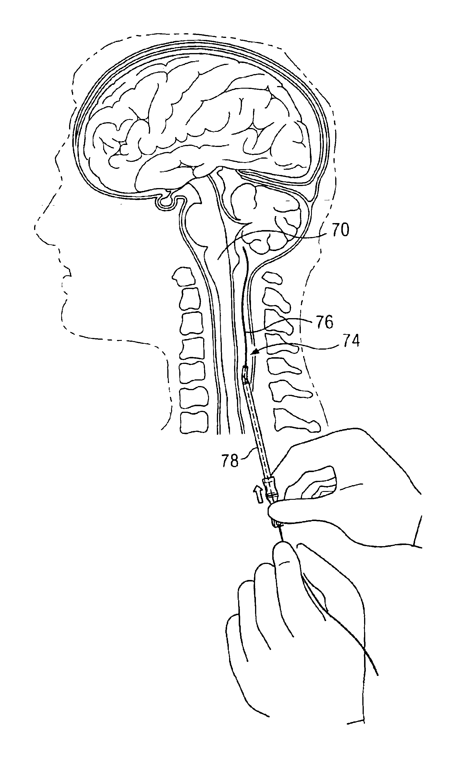 System and method for stimulation of a person's brain stem