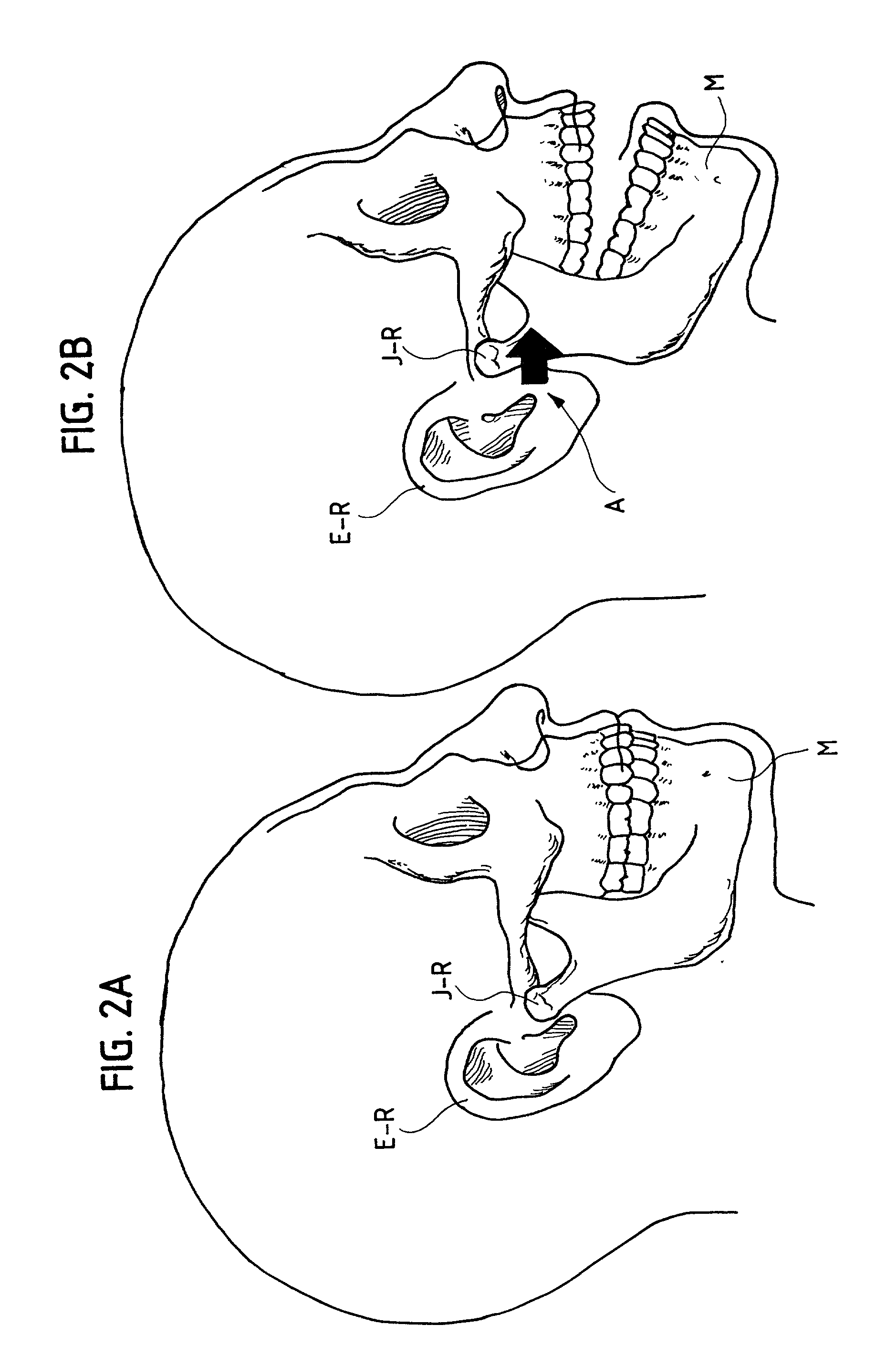 Compressible hearing aid