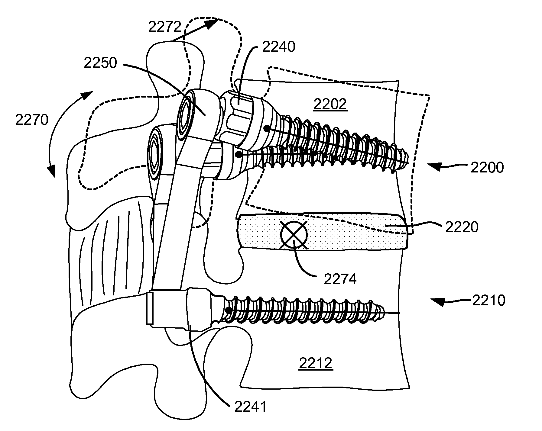 Spinal prosthesis having a three bar linkage for motion preservation and dynamic stabilization of the spine