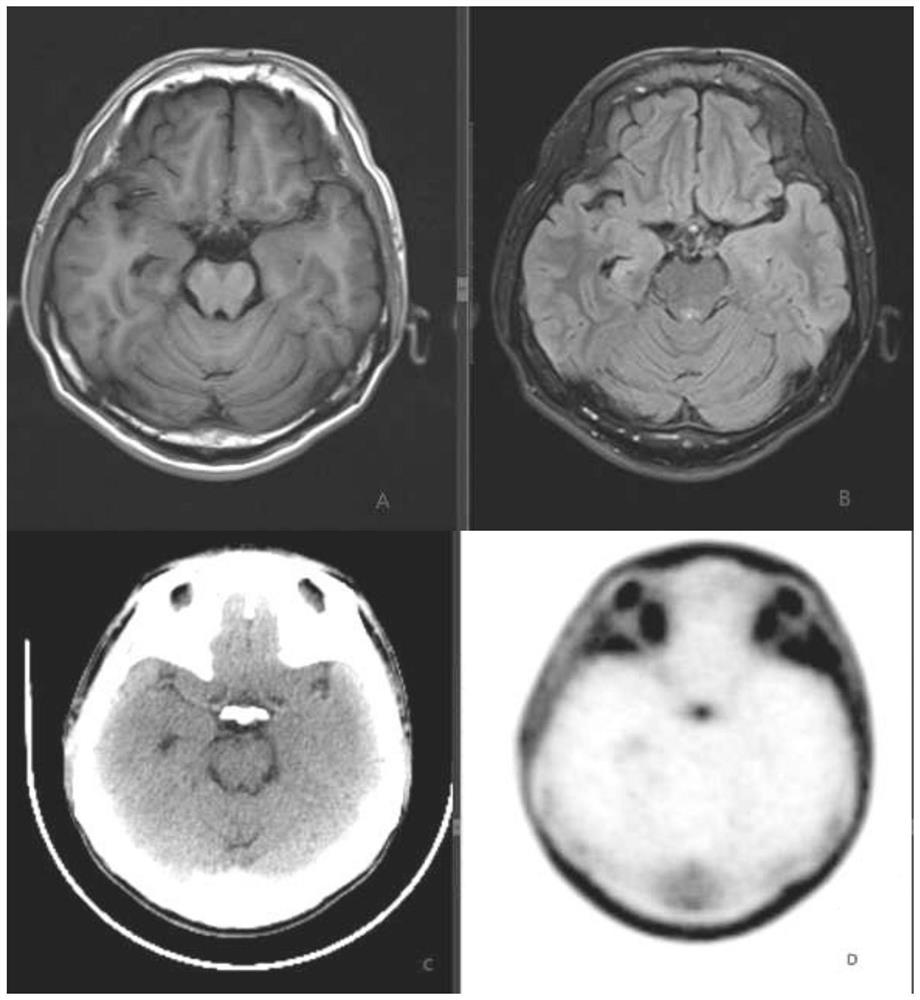 Method and system for identifying epileptic focus of temporal lobe epilepsy caused by hippocampal sclerosis and/or predicting pathological typing of epilepsy