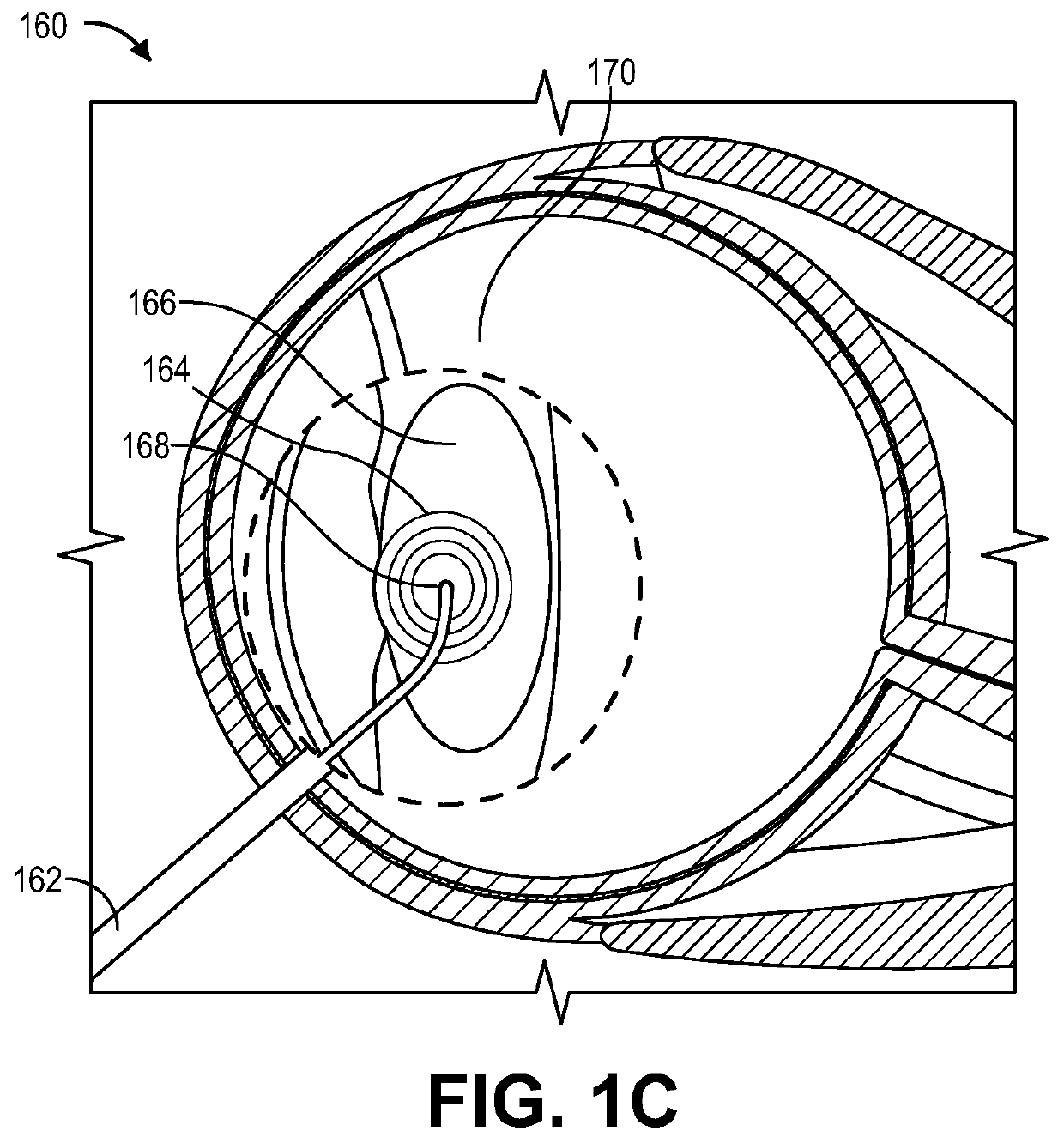 Method for eye lens removal using cavitating microbubbles