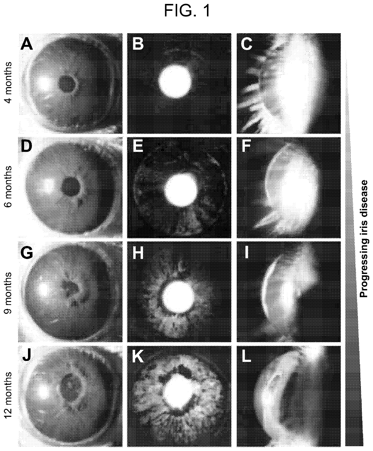 Fat droplets in retina and optic nerve as a diagnostic marker for neurodegeneration and glaucoma in humans