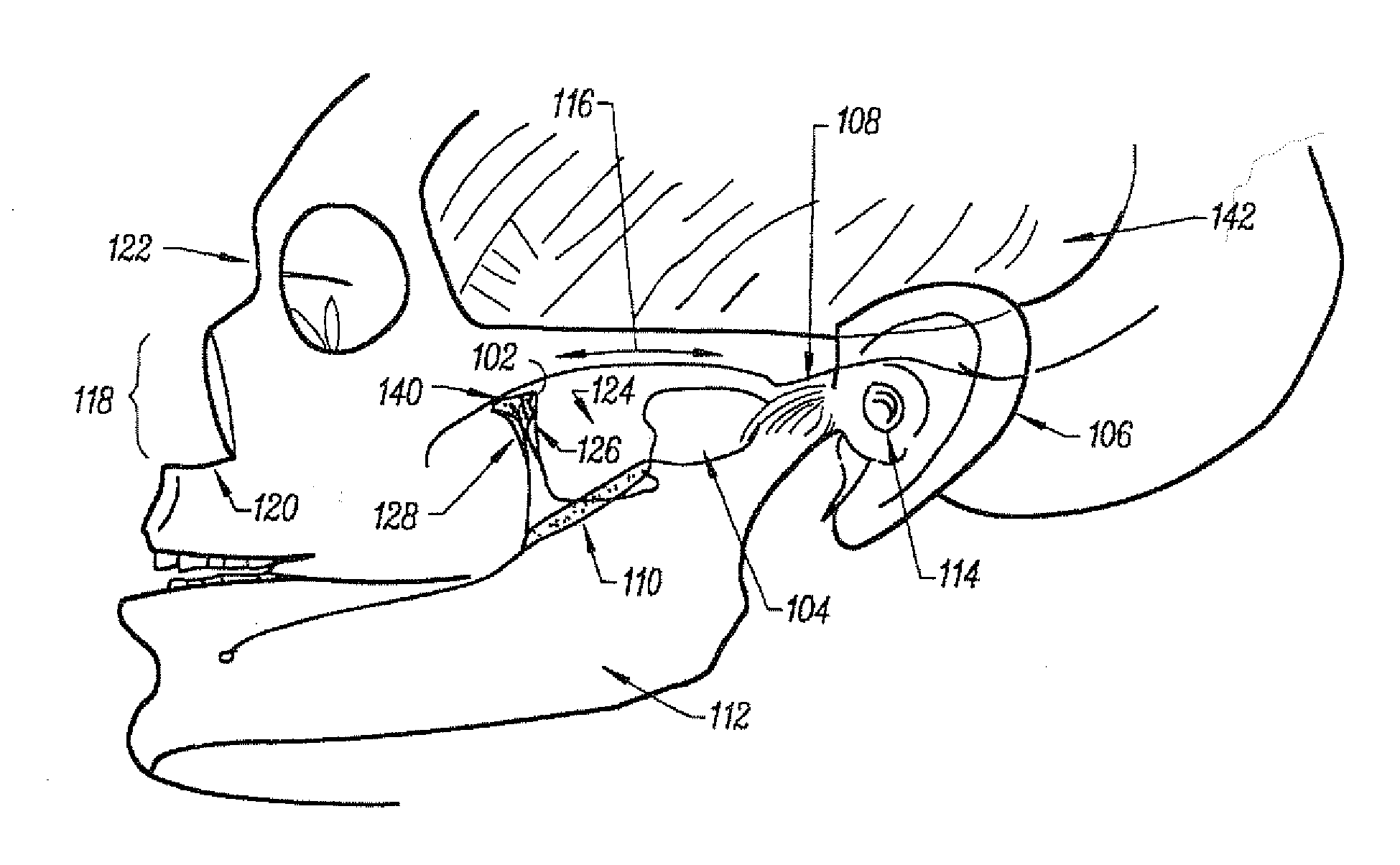 Stimulation method for the sphenopalatine ganglia, sphenopalatine nerve, or vidian nerve for treatment of medical conditions