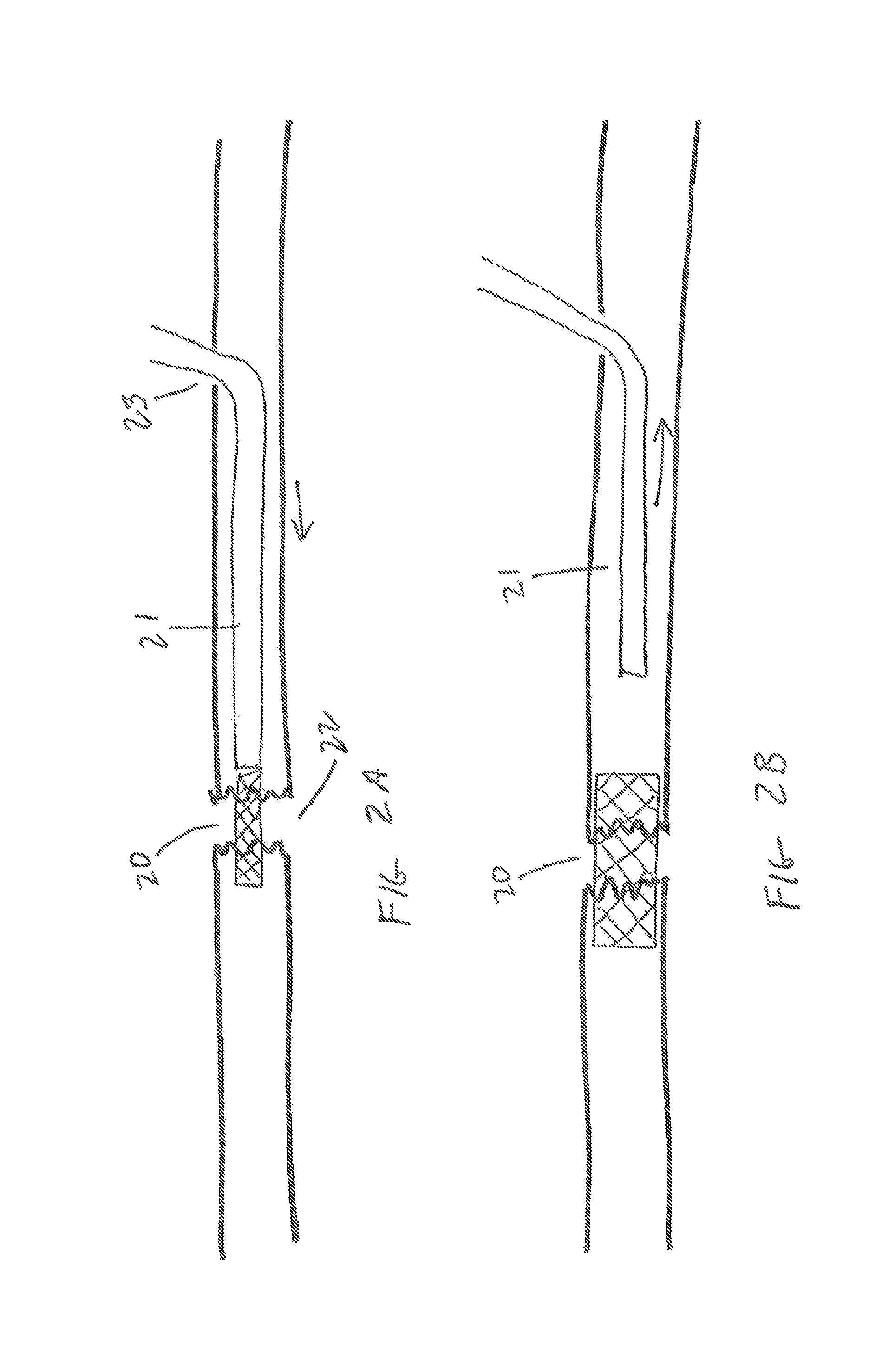 Method and devices for the treatment of nasal sinus disorders