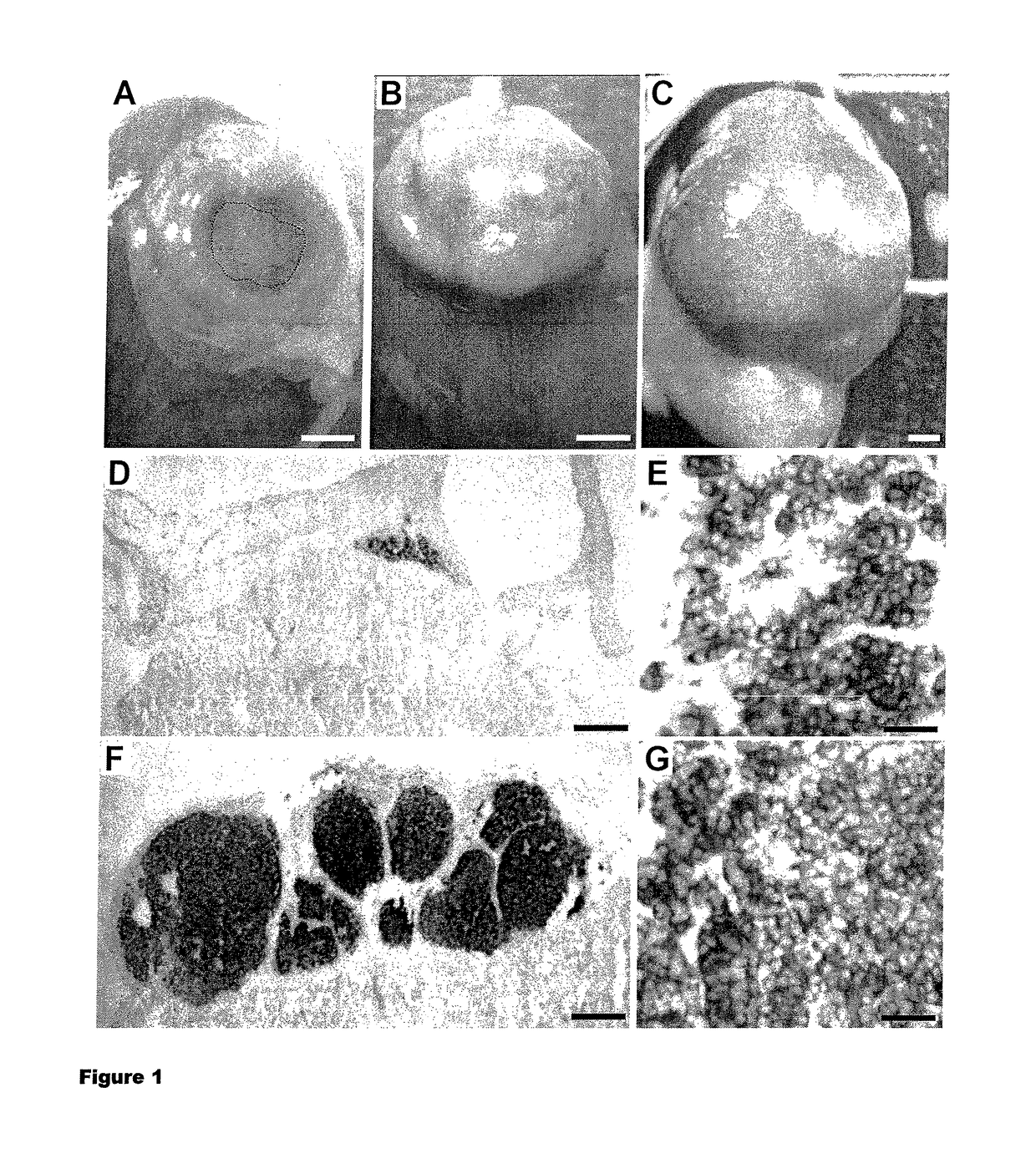 Human pancreatic beta cell lines for diagnostic of diabetes