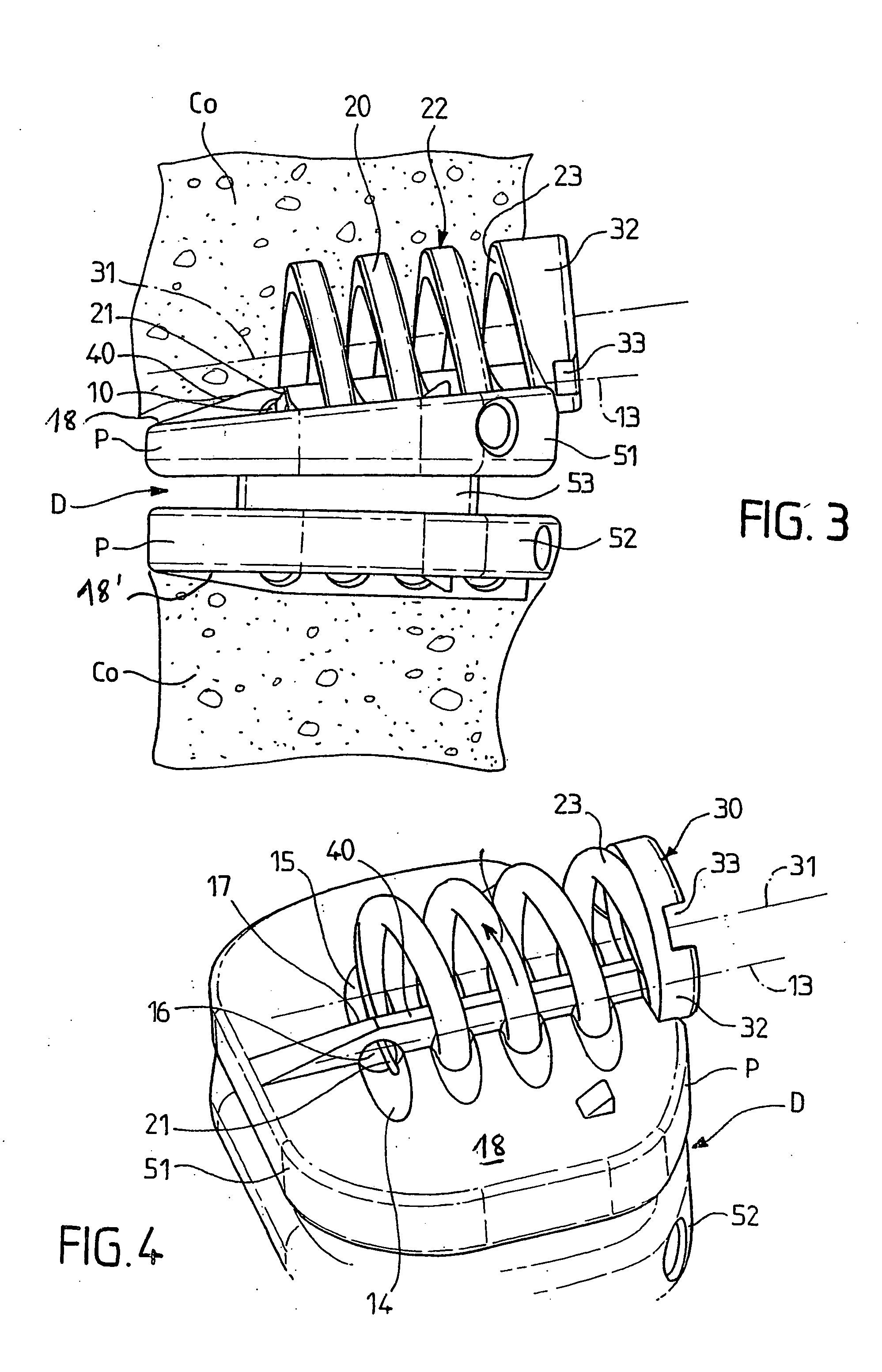 System for fixing a part to a bone element