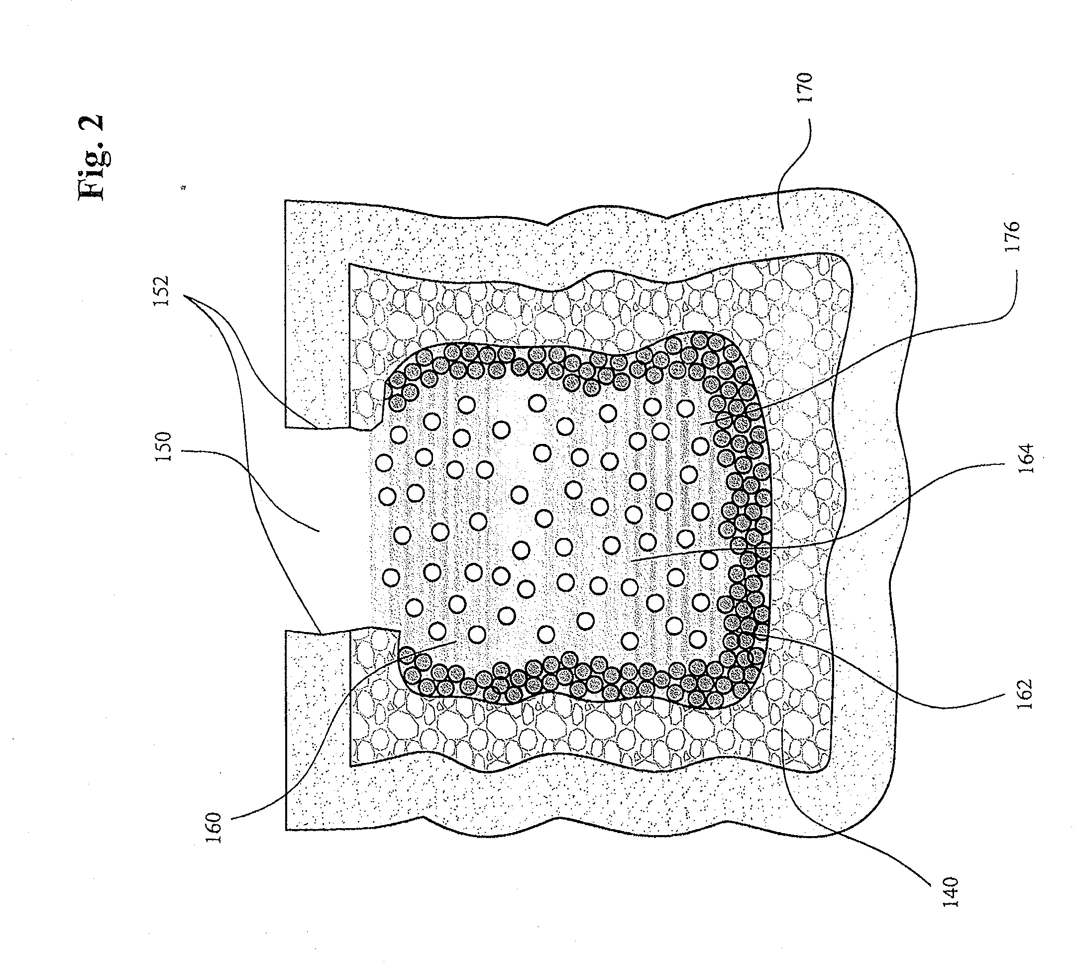 Bone cement composite containing particles in a non-uniform spatial distribution and devices for implementation