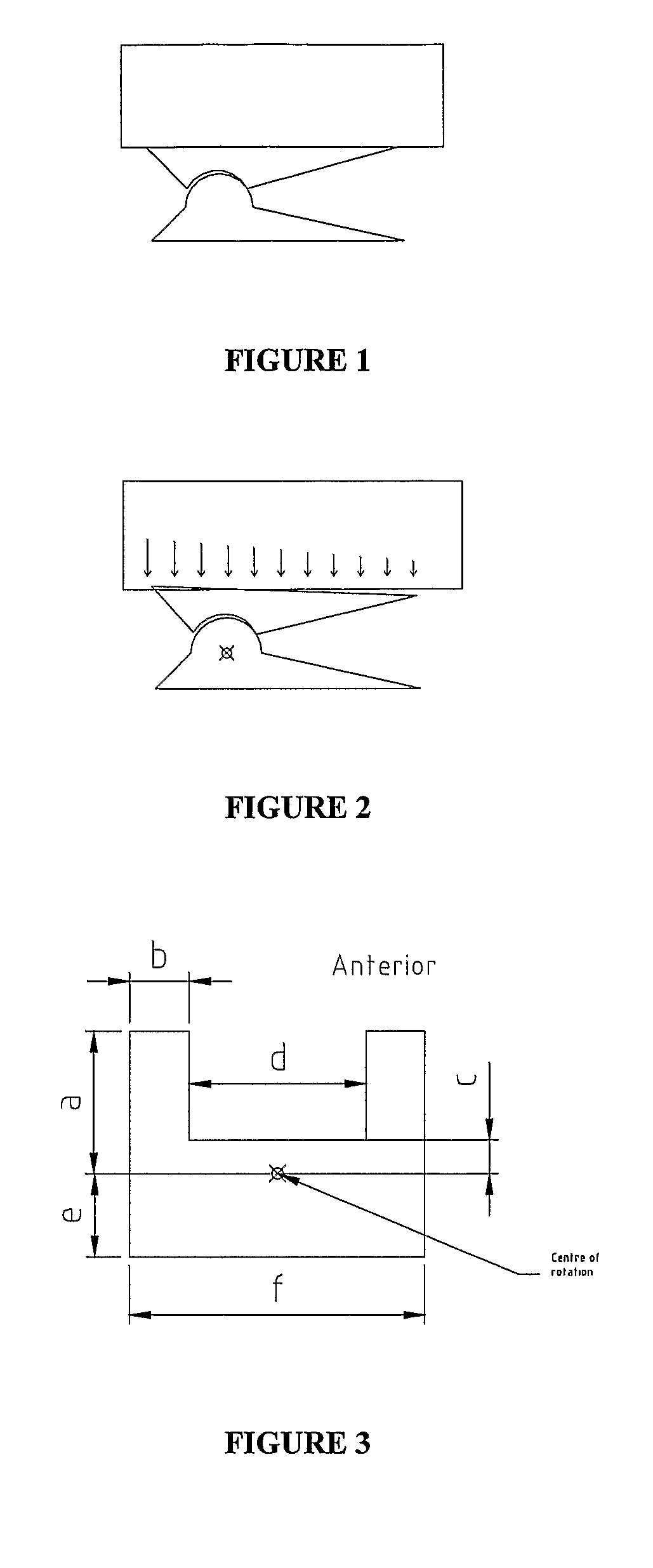Method of Reducing Loading Failure for a Prosthetic Component