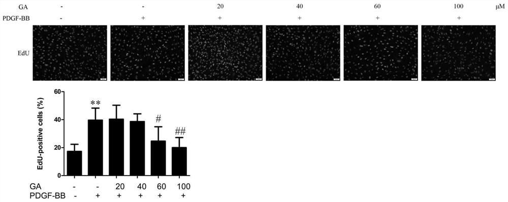 Application of ginkgolic acid in preparation and treatment of drug for treating vascular restenosis diseases