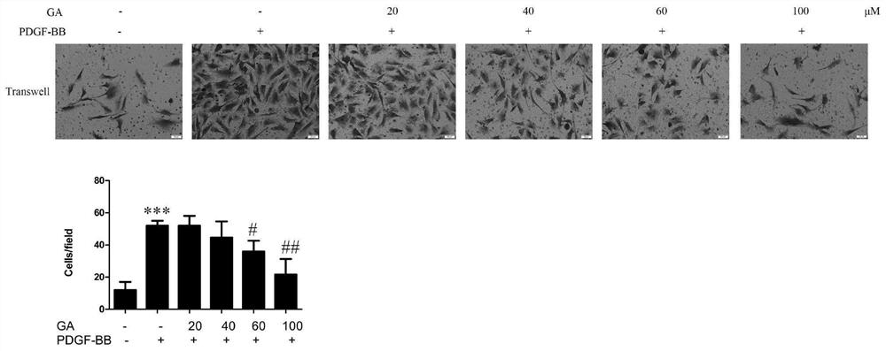 Application of ginkgolic acid in preparation and treatment of drug for treating vascular restenosis diseases