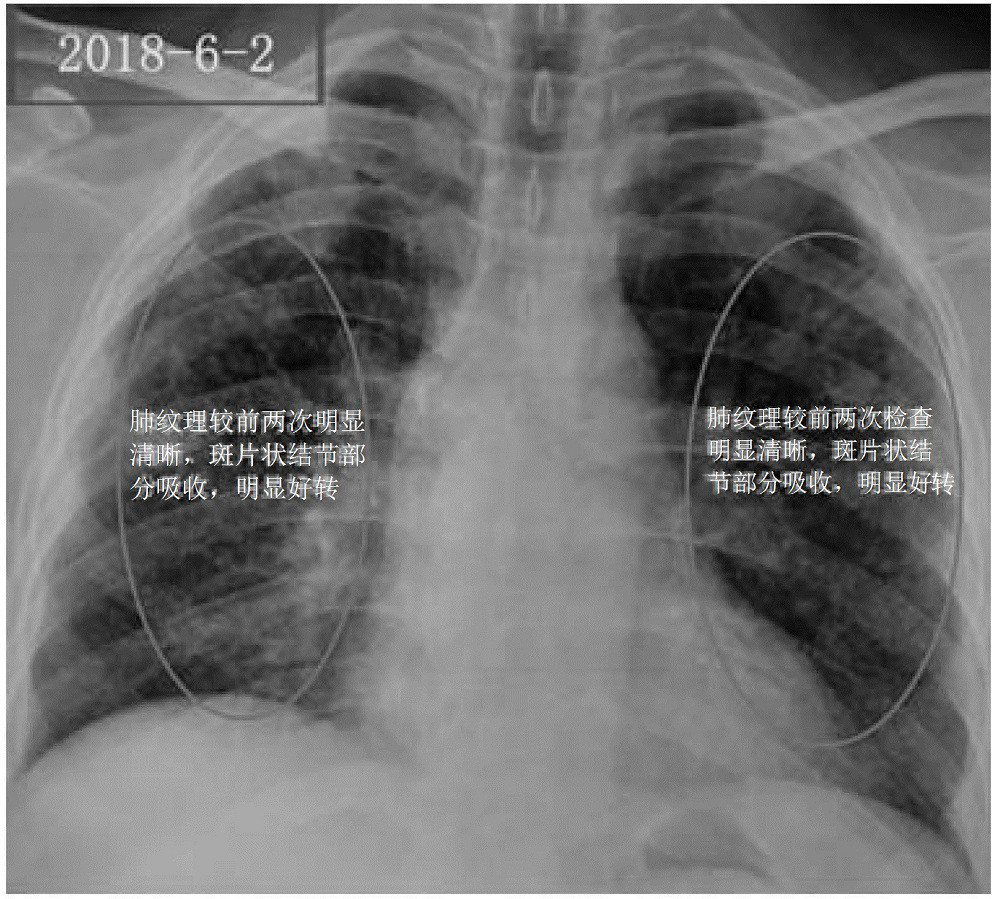 A traditional Chinese medicine compound composition for treating pneumoconiosis and pulmonary fibrosis and its preparation method