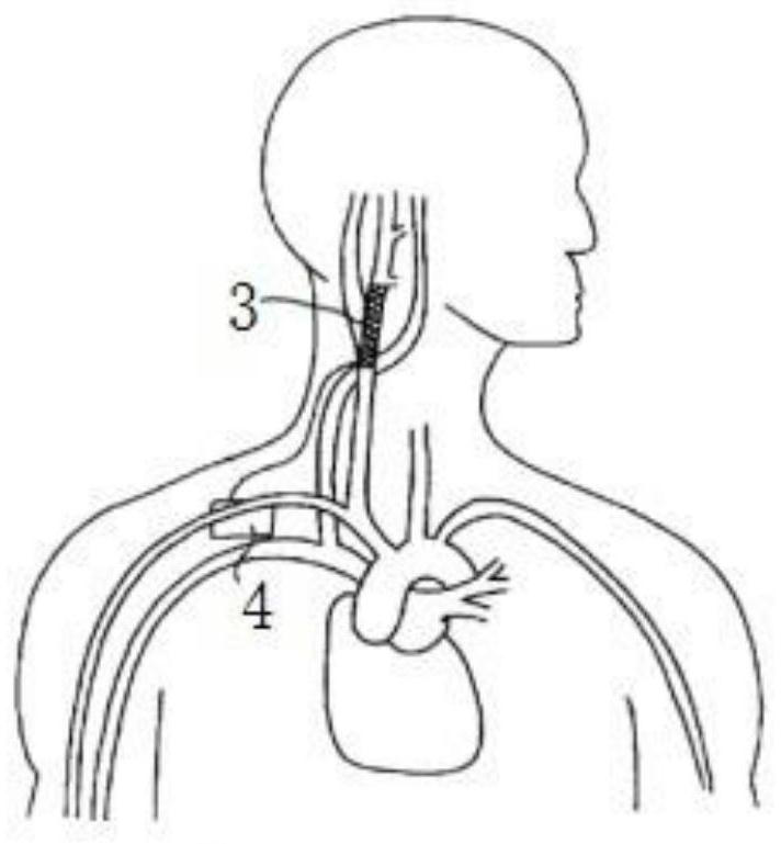 Carotid sinus pressure receptor stimulation device