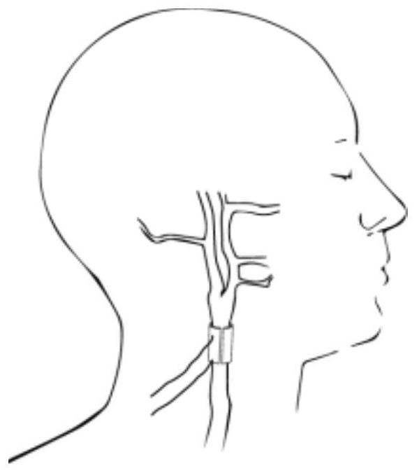 Carotid sinus pressure receptor stimulation device