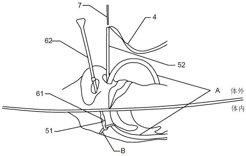 Nasal catheter limiting tool fixed in nasal cavity