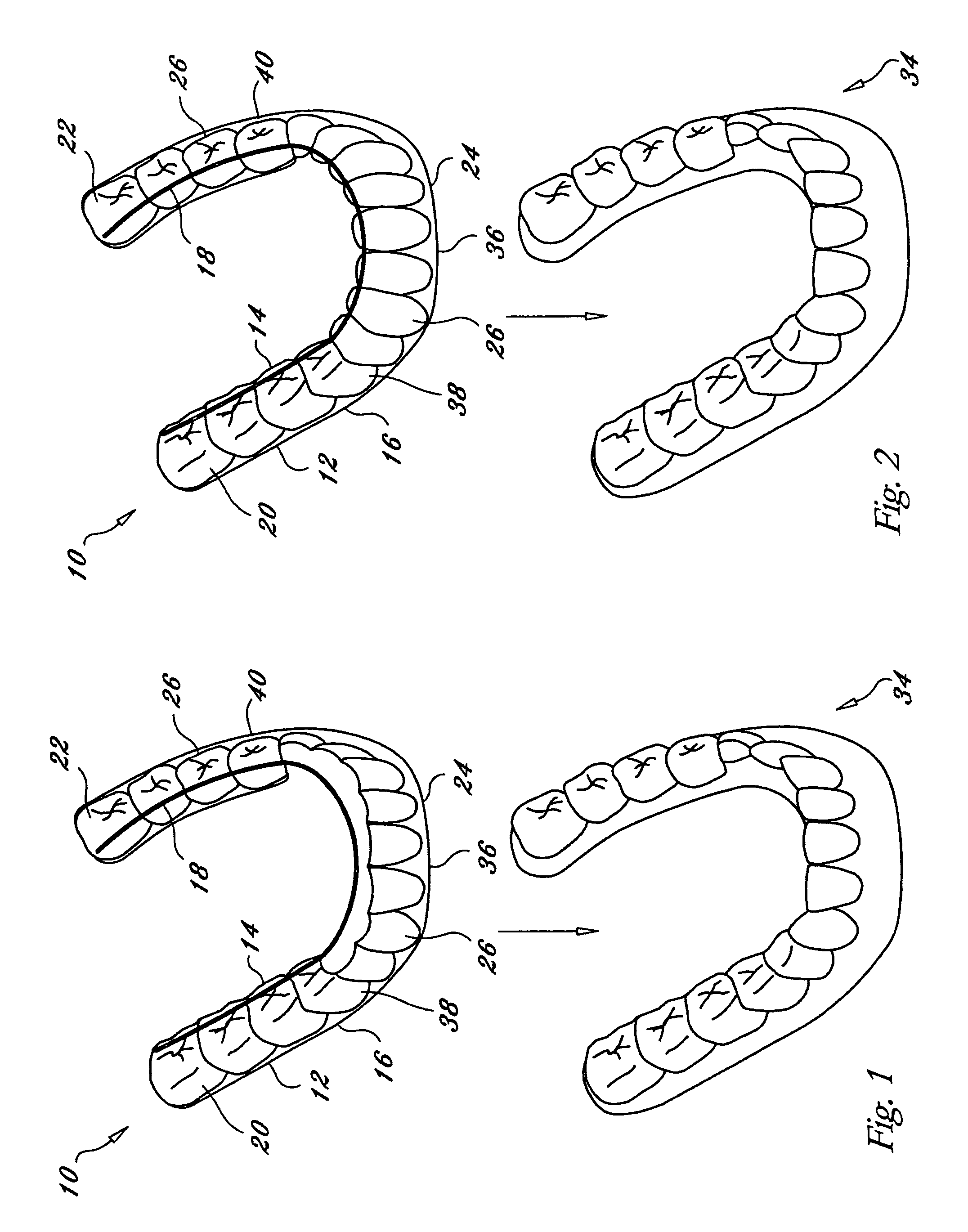 Orthodontic appliance with embedded wire for moving teeth and method