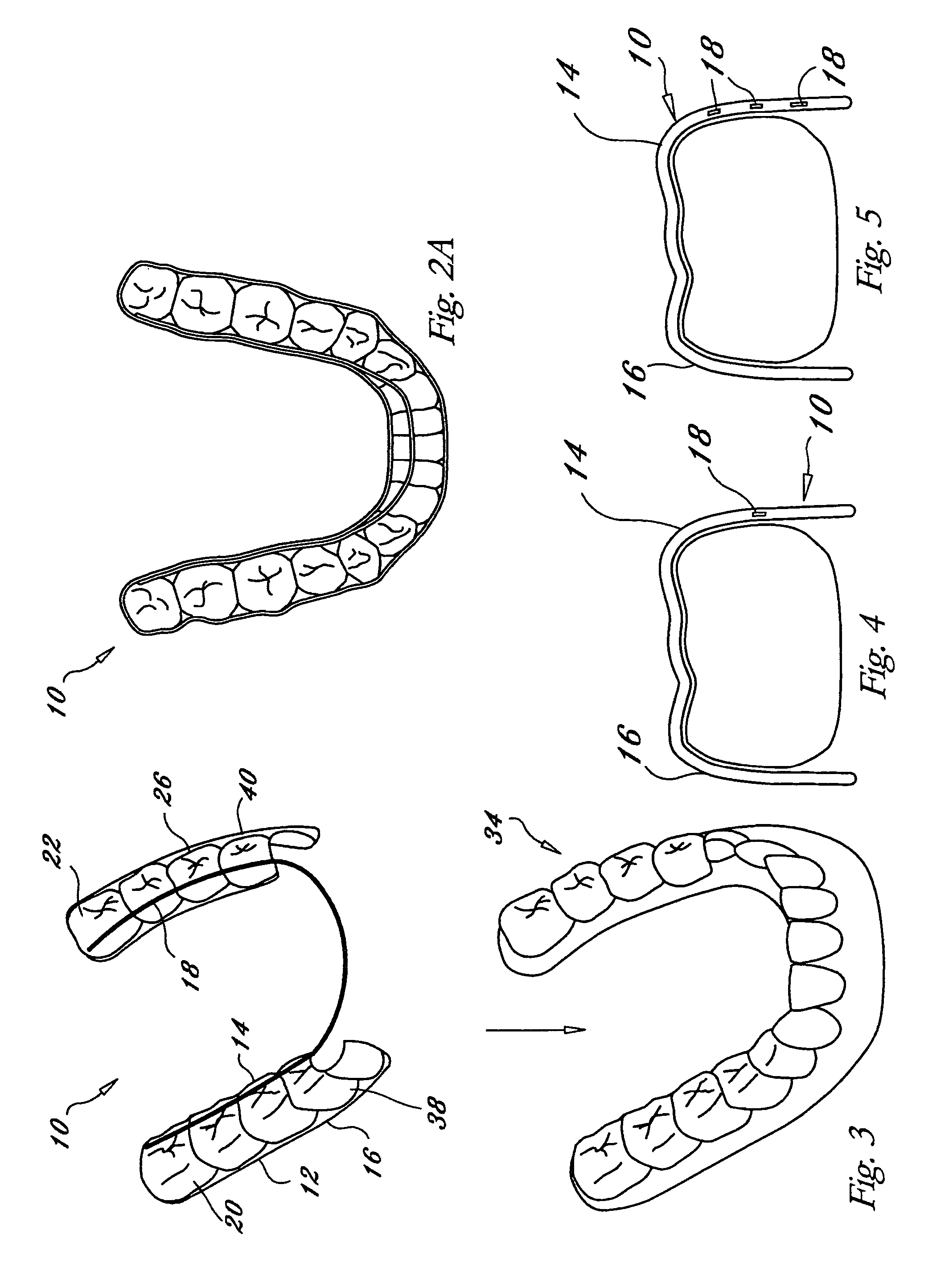 Orthodontic appliance with embedded wire for moving teeth and method