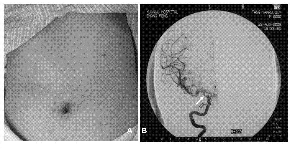 I type neurofibroma NF1 gene mutation nucleotide sequence related to cerebrovascular stenosis and application thereof