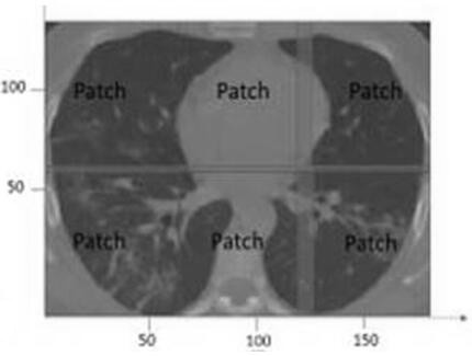 CT pneumonia focus automatic processing system based on deep learning