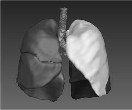 CT pneumonia focus automatic processing system based on deep learning