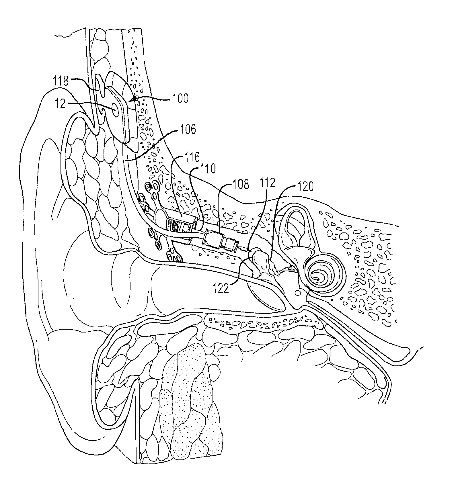 Adaptive cancellation system for implantable hearing instruments