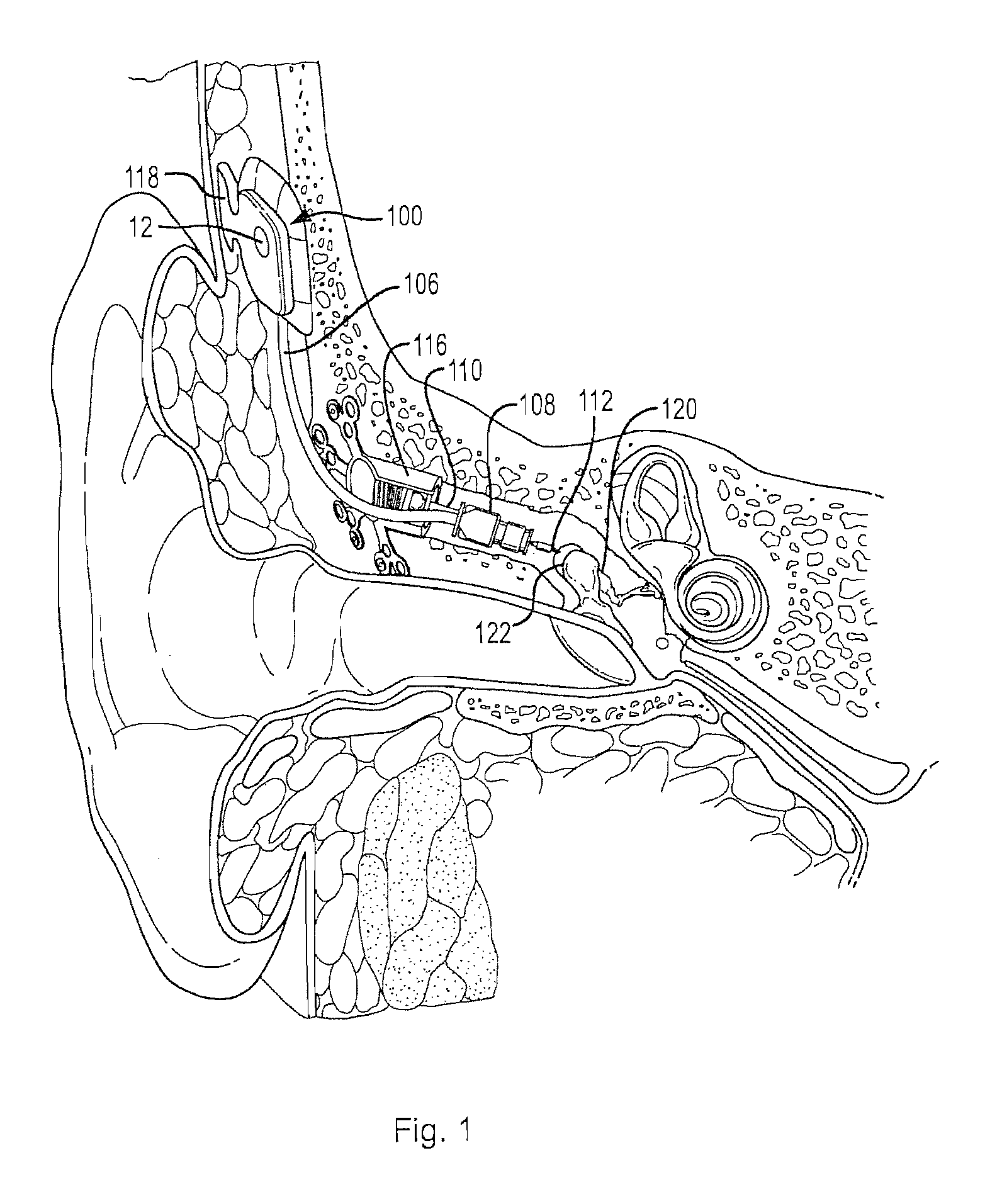 Adaptive cancellation system for implantable hearing instruments