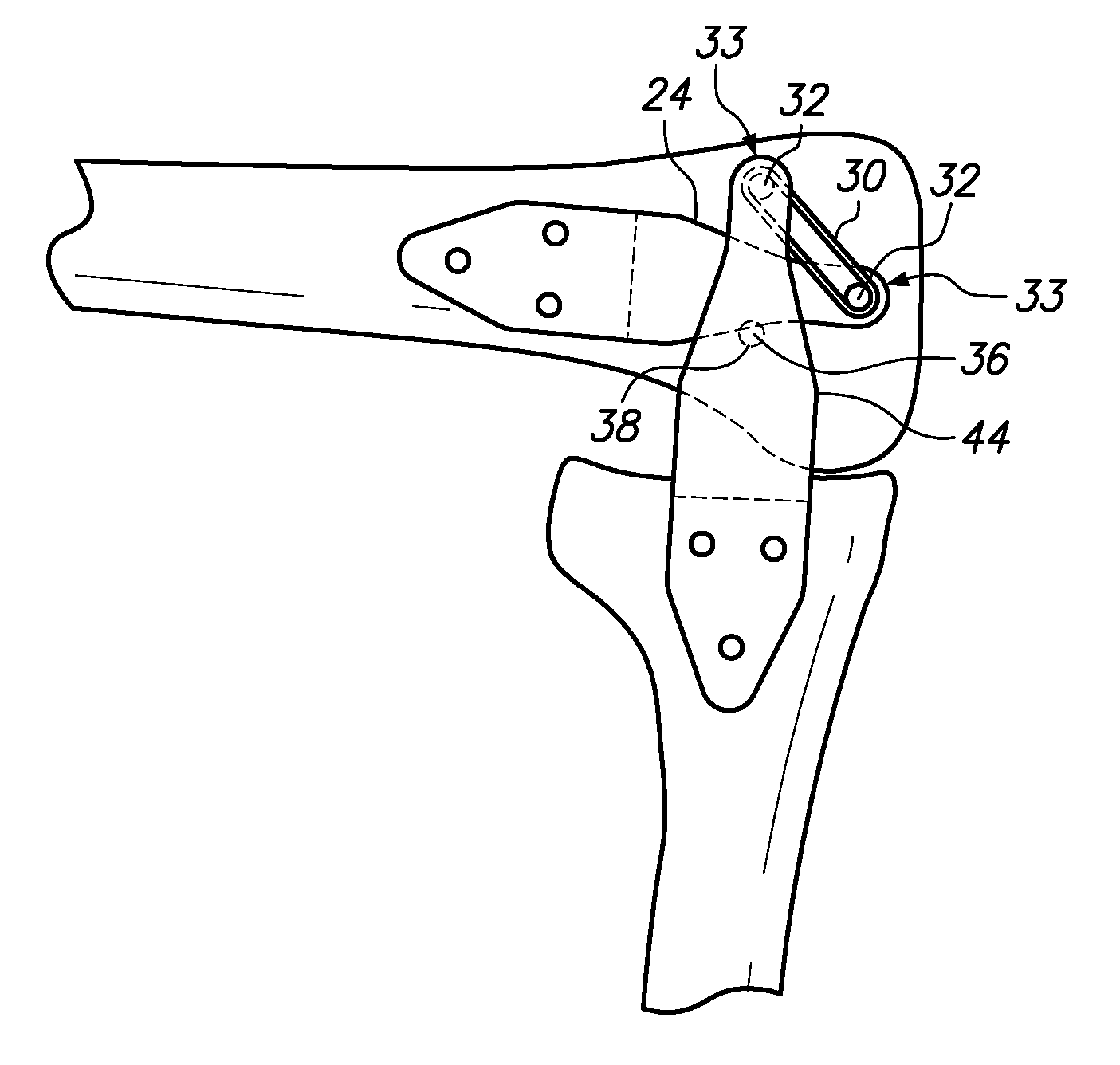 Extra-articular implantable mechanical energy absorbing assemblies having a tension member, and methods
