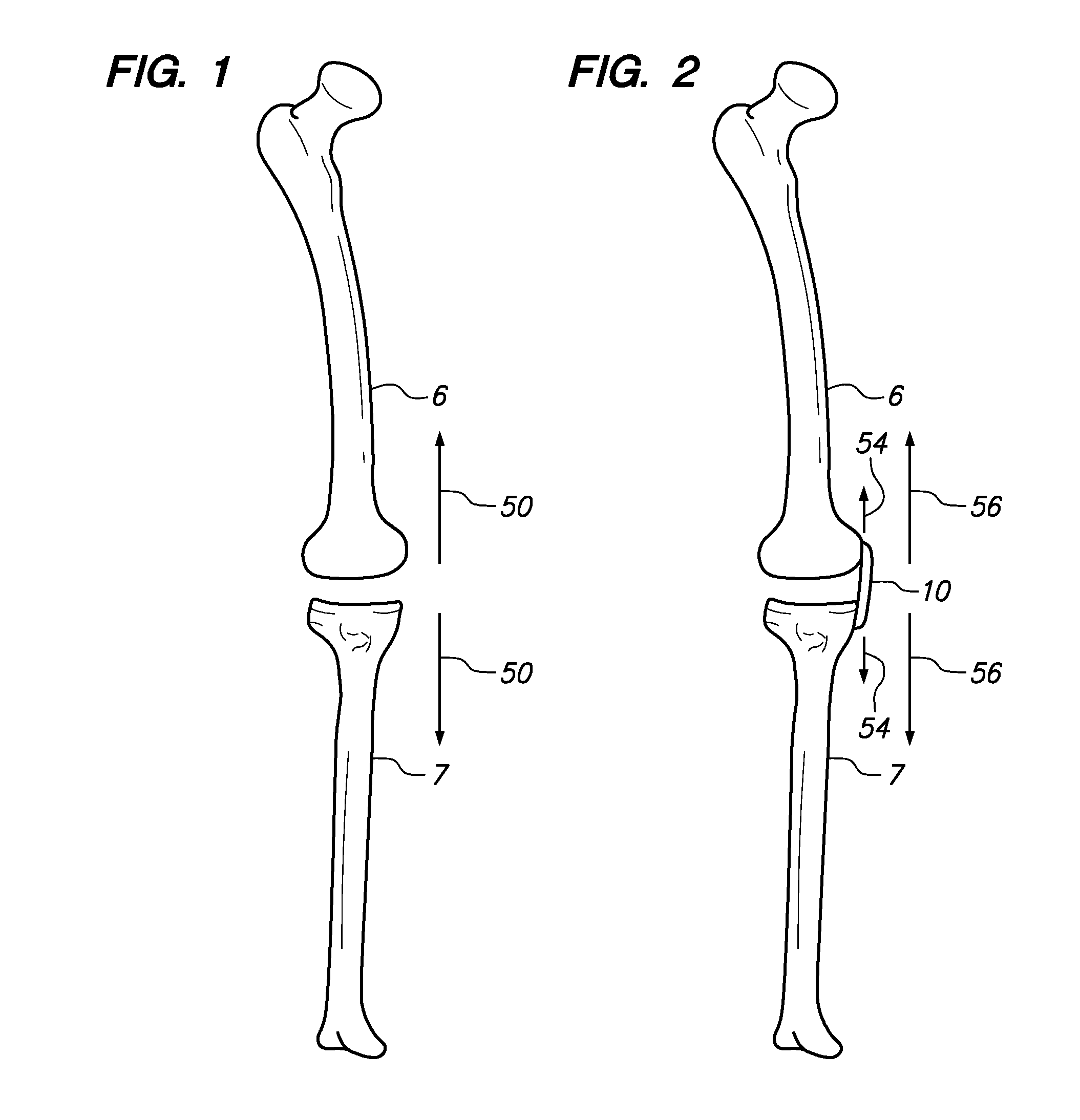 Extra-articular implantable mechanical energy absorbing assemblies having a tension member, and methods