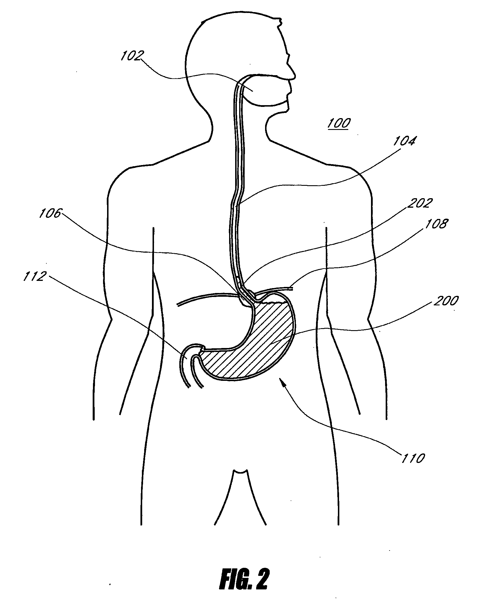 Method and apparatus for adjusting body lumens
