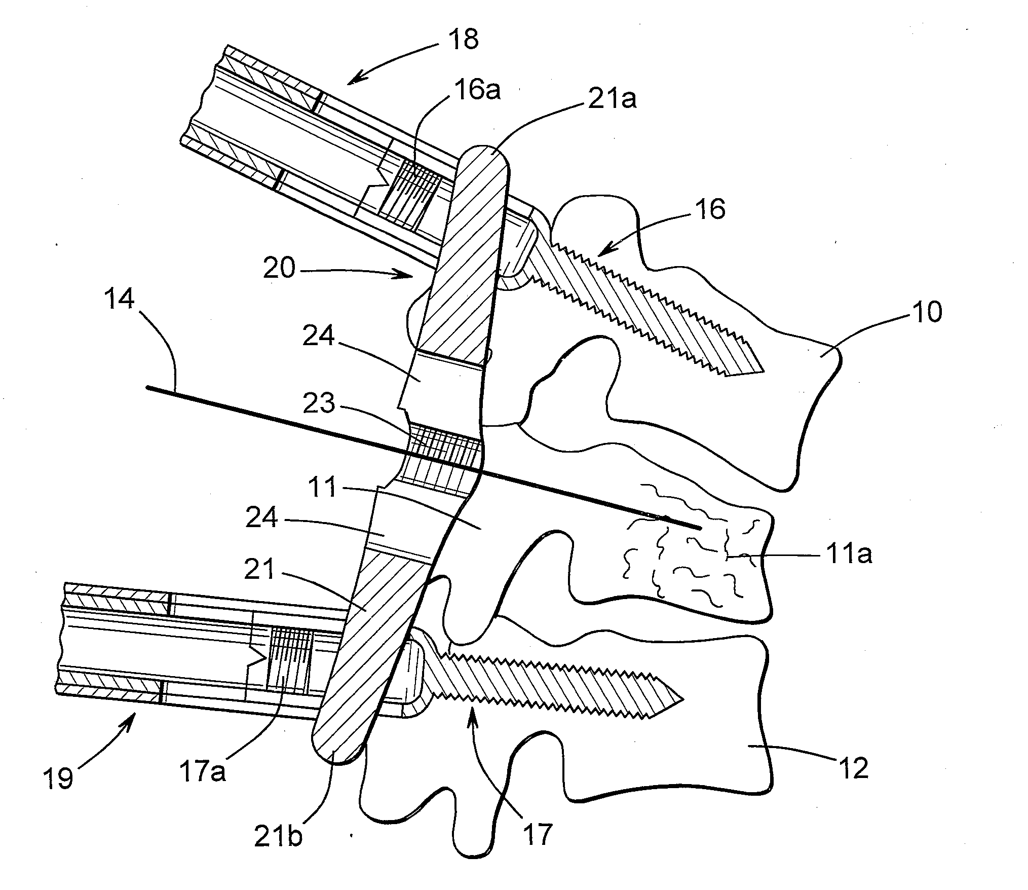 Posterior fixation device for percutaneous stabilization of thoracic and lumbar burst fractures