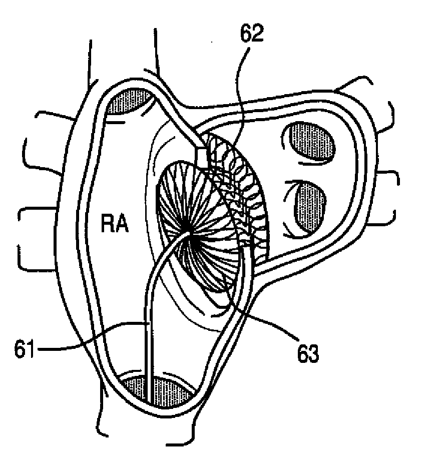Atrial septal occluder device and method