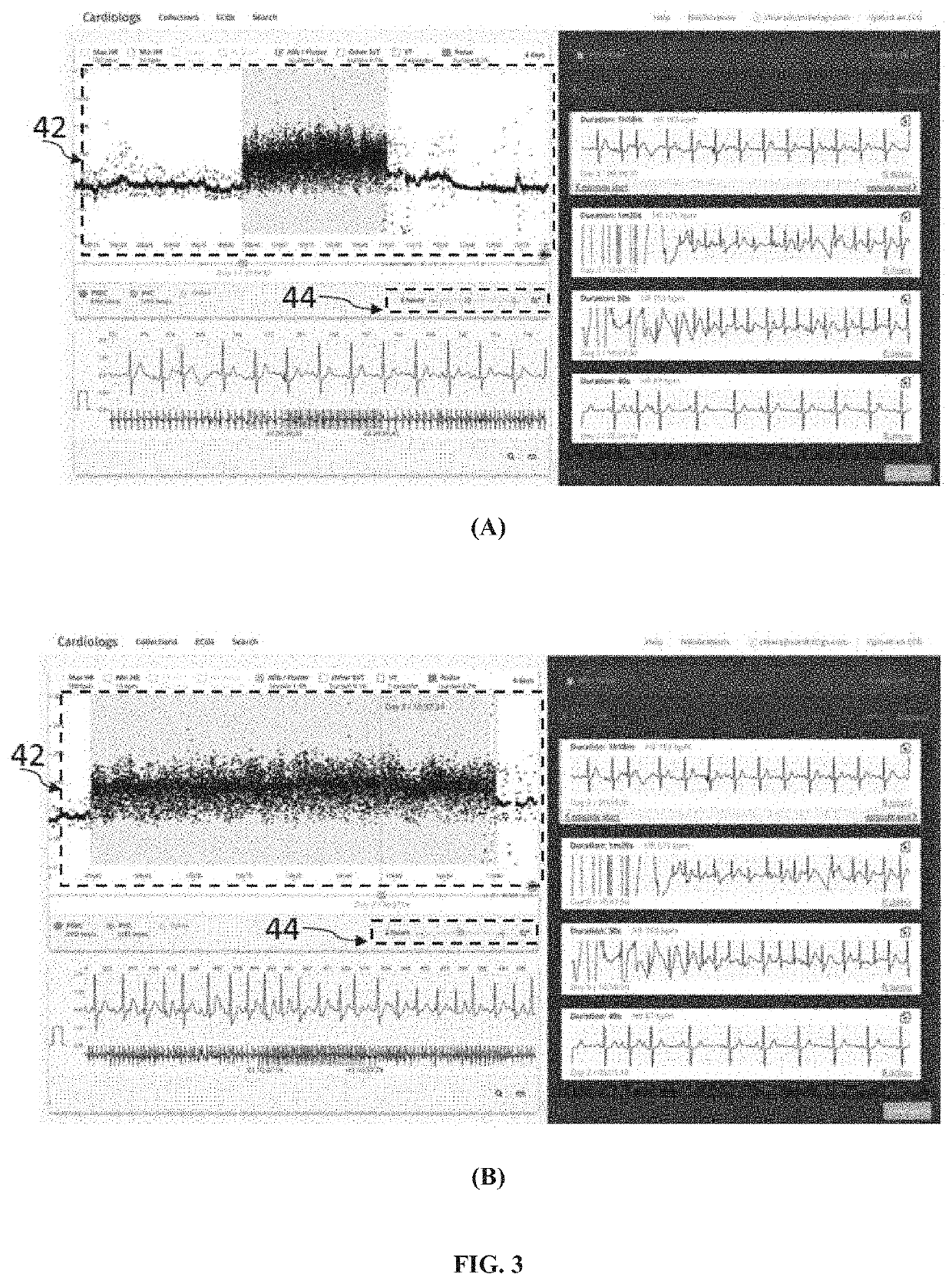 User interface for analysis of electrocardiograms