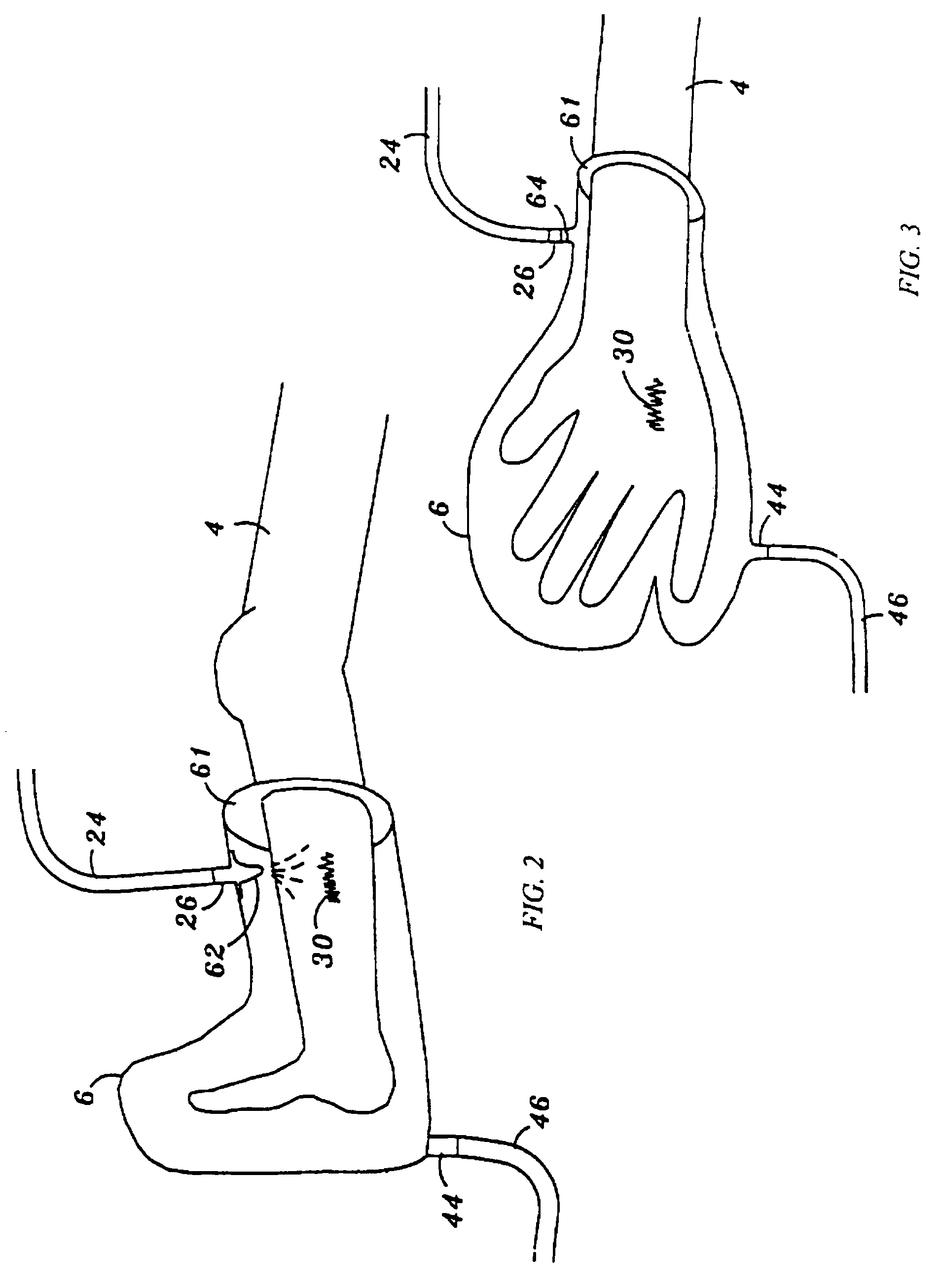 Device and method for treatment of wounds with nitric oxide