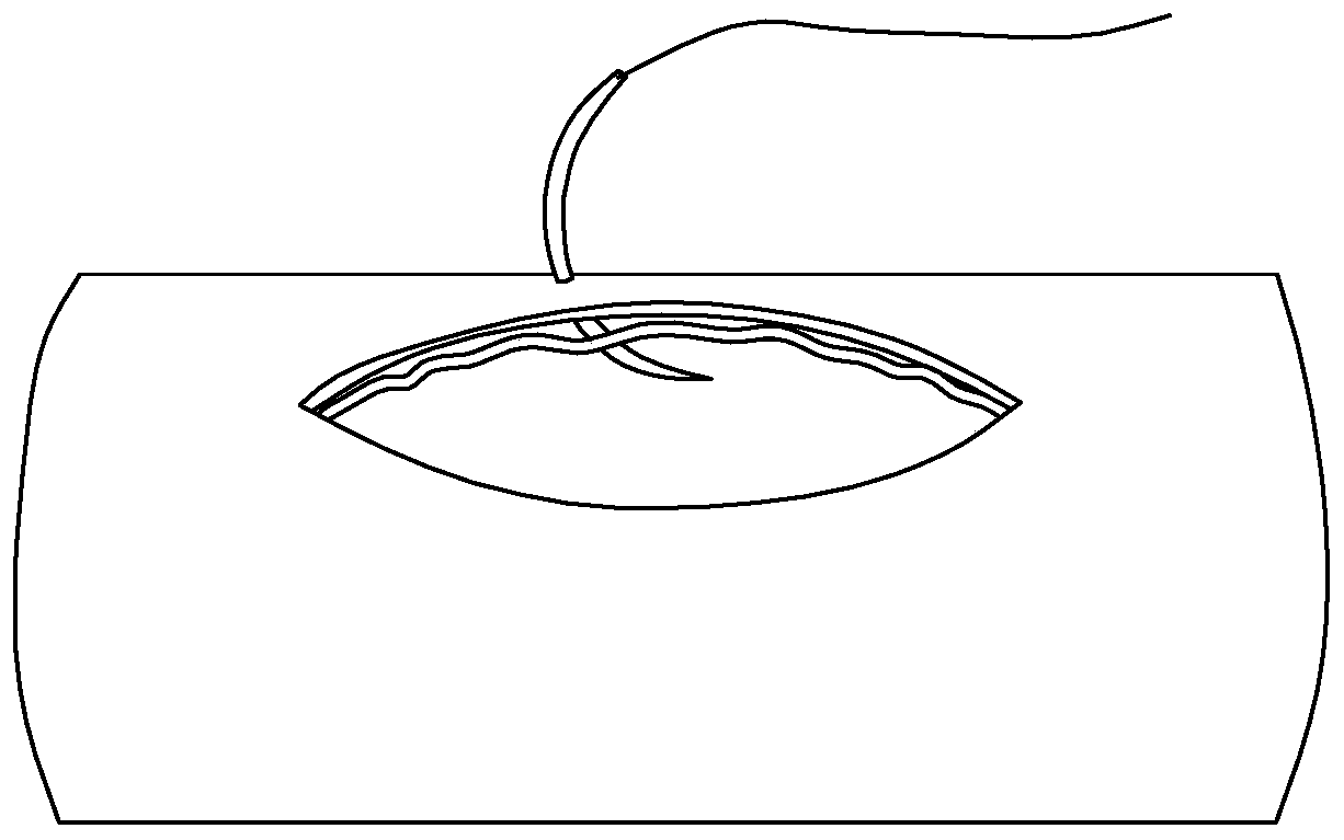 Blood vessel suturing device