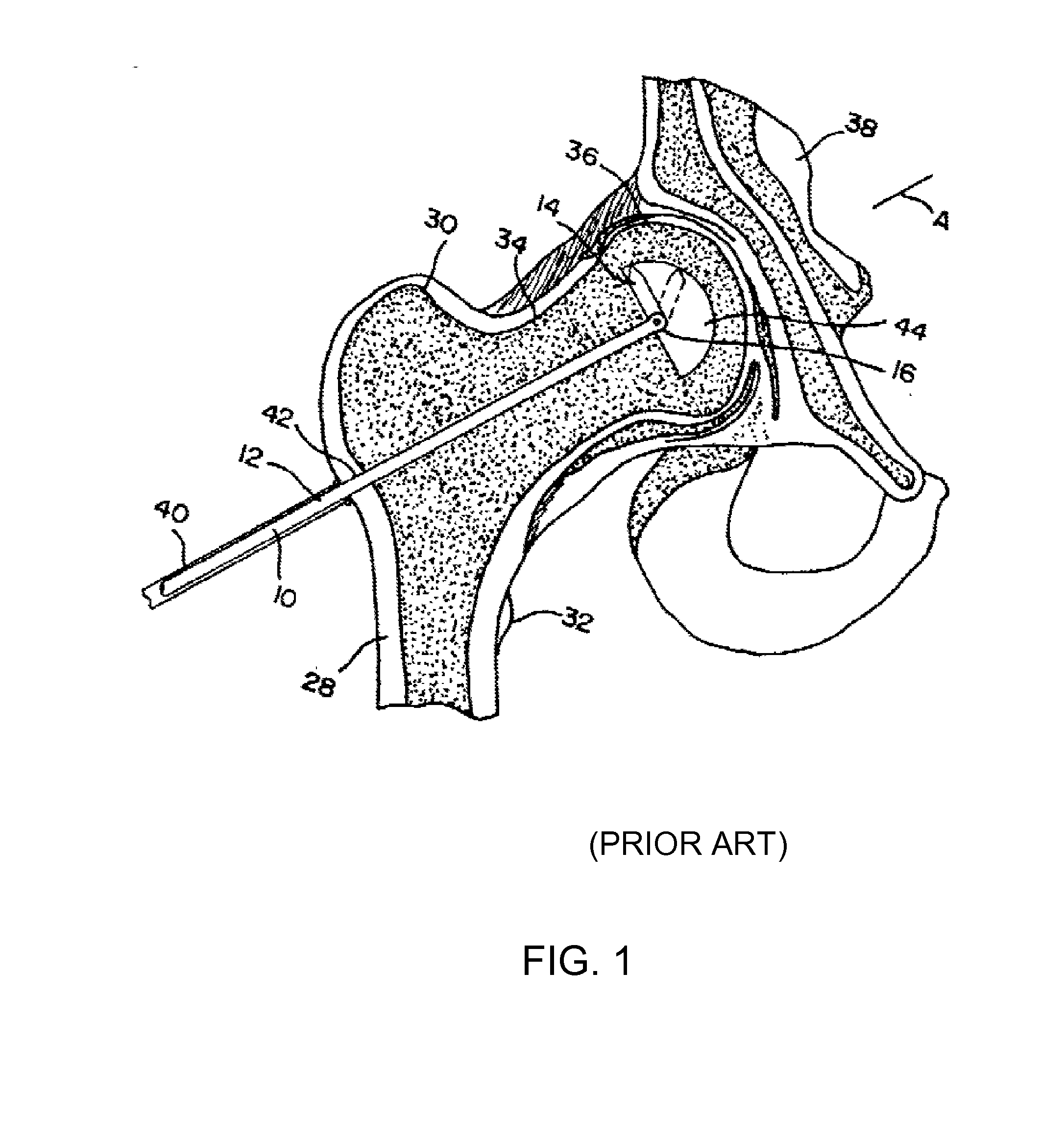 Tissue cavitation device and method