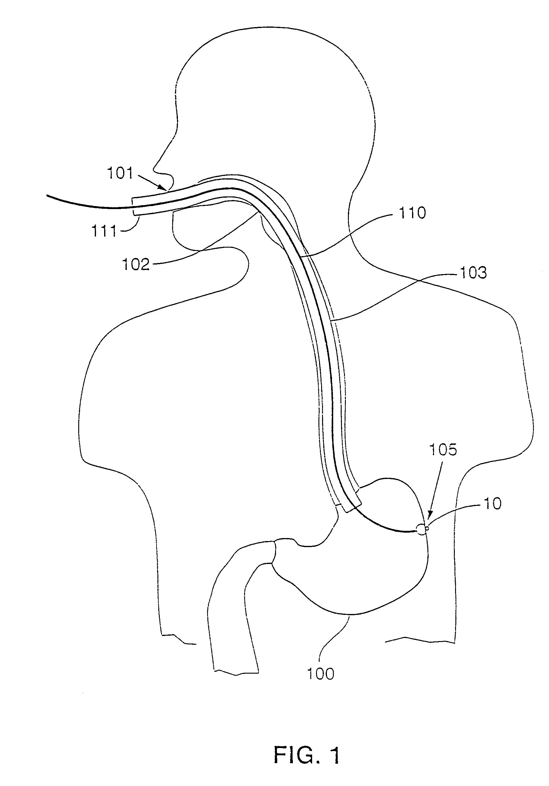 Gastric stimulation anchor and method