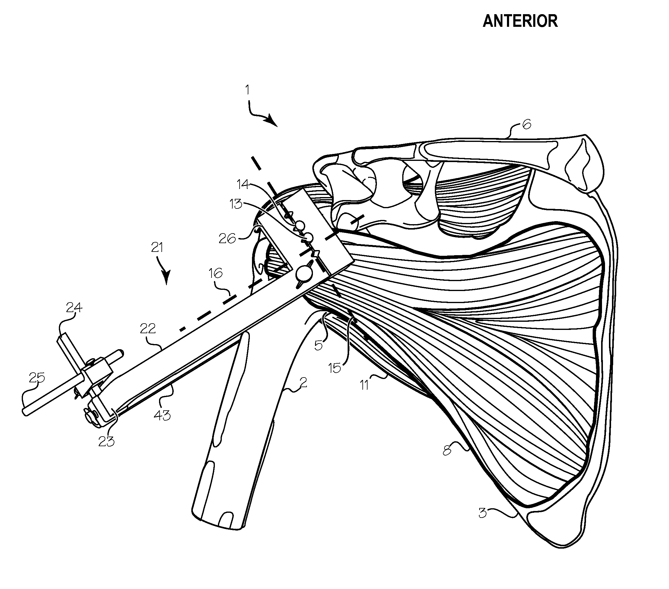 Method of Humeral Head Resurfacing and/or Replacement and System for Accomplishing the Method