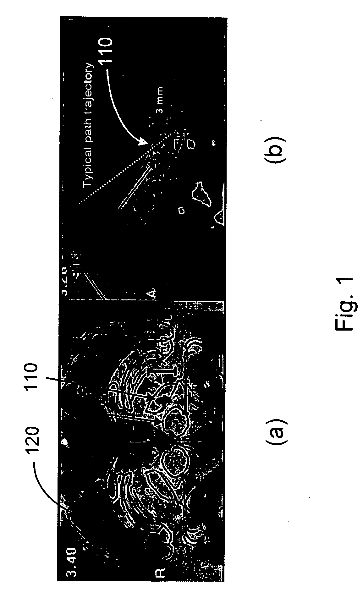 System and methods of deep brain stimulation for post-operation patients