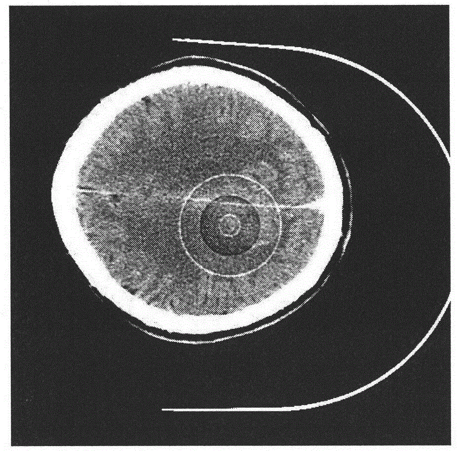 Post-processing method for removing ring artifacts in CT (computed tomography) image