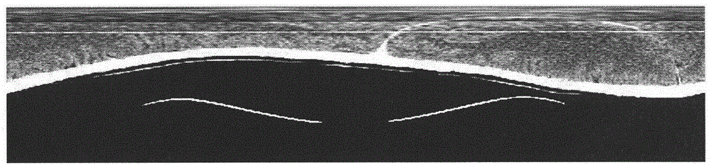 Post-processing method for removing ring artifacts in CT (computed tomography) image