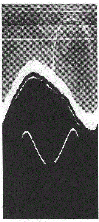 Post-processing method for removing ring artifacts in CT (computed tomography) image