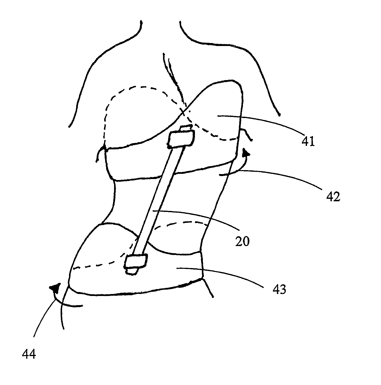 Derotational brace for treatment of idiopathic scoliosis