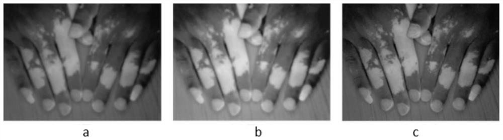 Enhancement method for ultraviolet fluorescence image of skin disease