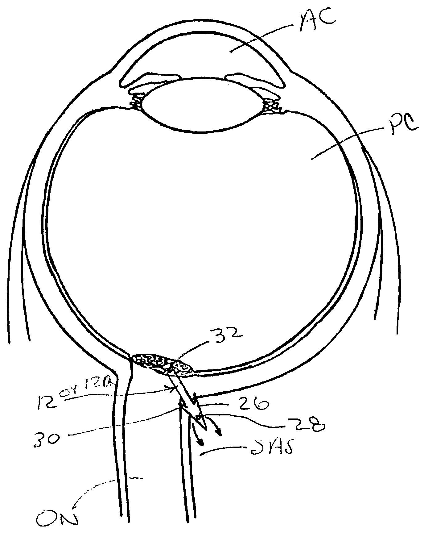 Methods and devices for draining fluids and lowering intraocular pressure