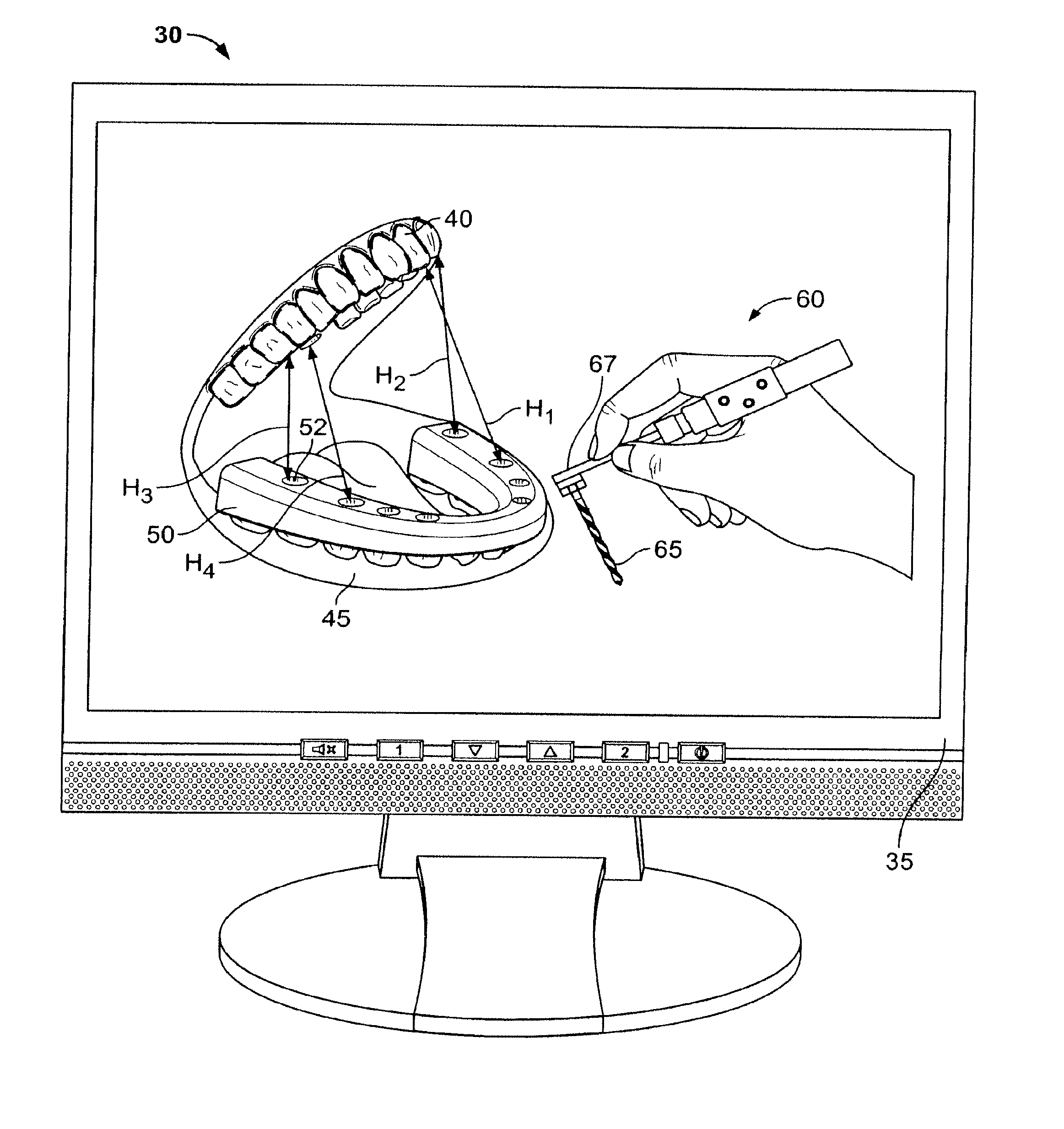 Method For Pre-Operative Visualization Of Instrumentation Used With A Surgical Guide For Dental Implant Placement