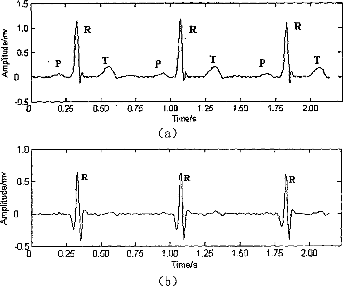 Cardioelectric characteristic extracting process based on evolutive wavelet wiener deconvolution