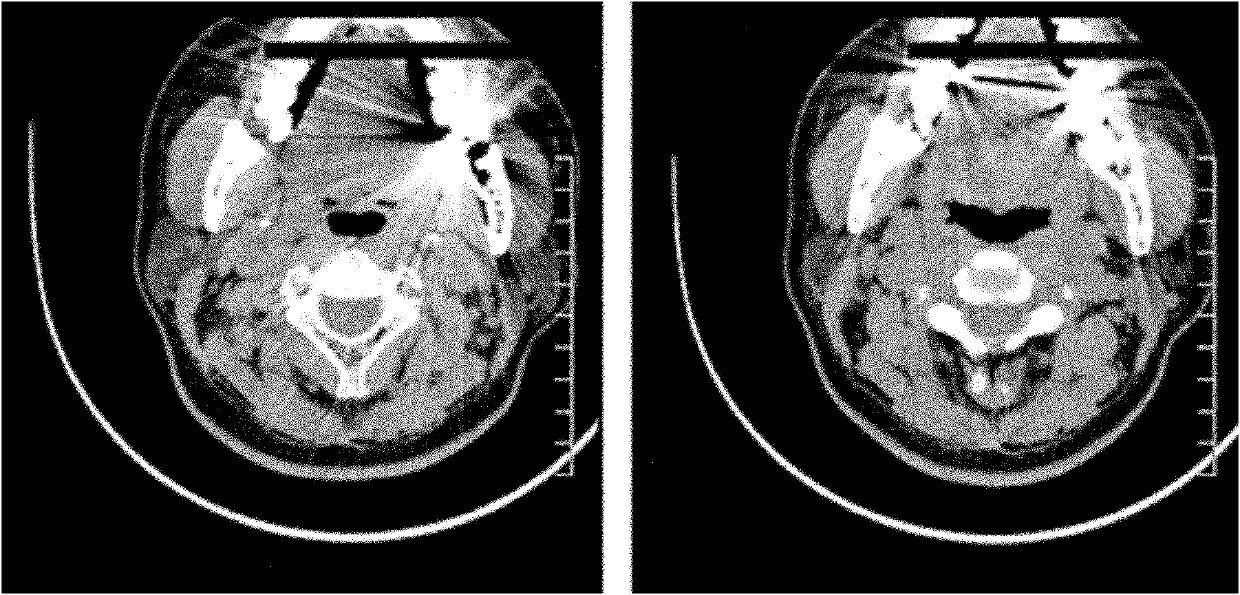 Image postprocessing method for removing metal artifact from computed tomography (CT) image