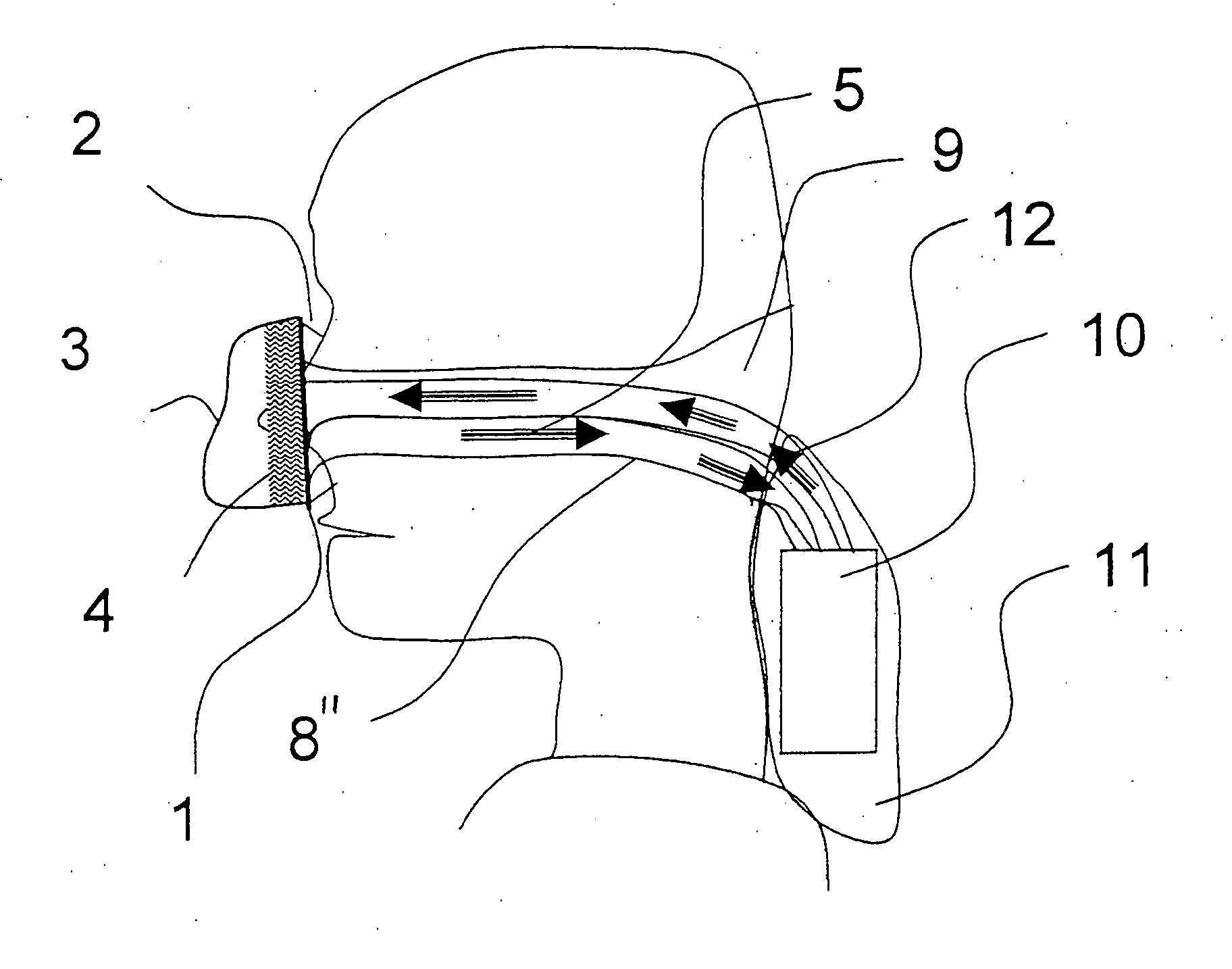 Breathing mask with integrated suction area