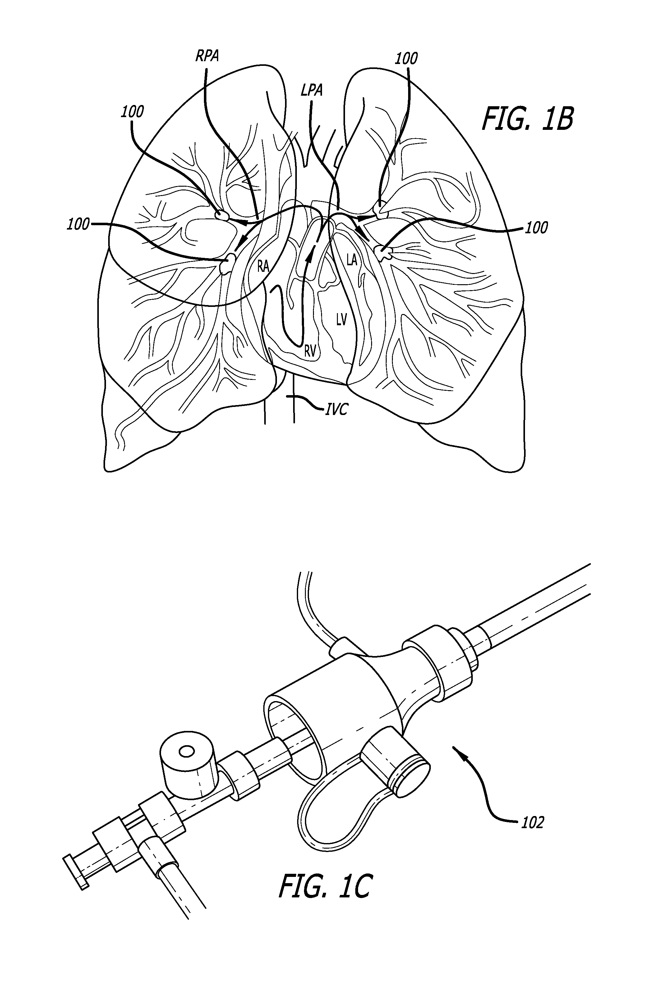 Methods and apparatus for treating embolism